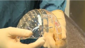 L'avancée technologique permet de créer des prothèses du crâne imprimées en 3D